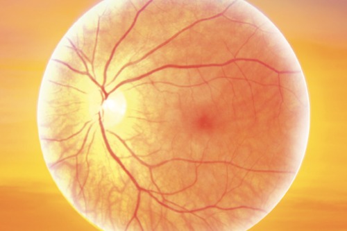 玻璃体浑浊动画示图