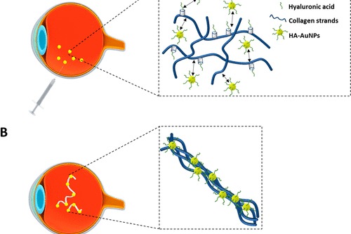 玻璃体浑浊症状示意图