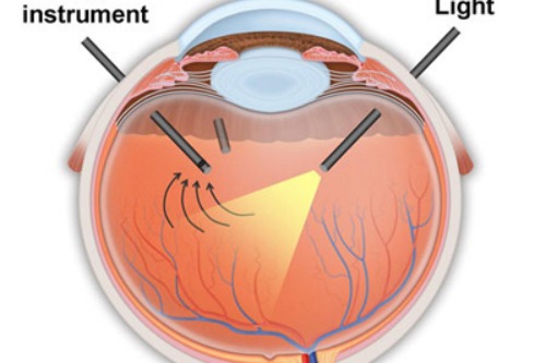 玻璃体切除术后眼睛还能看见吗？每个人的恢复过程是独特的，结果因人而异！