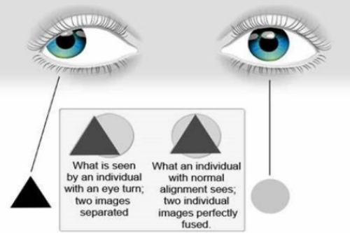 亲身经历：揭秘弱视症状与影响，从“会不会失明”说起！