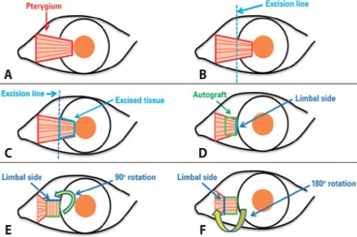 不同类型翼状胬肉对比示意图 不同类型翼状胬肉对比示意图