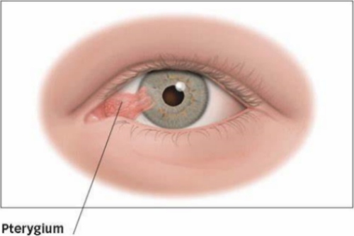翼状胬肉示意图 翼状胬肉示意图