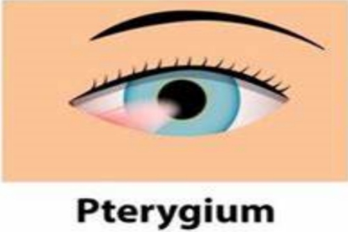 翼状胬肉示意图 翼状胬肉示意图