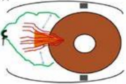 翼状胬肉示意图 翼状胬肉示意图