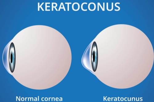 圆锥角膜示意图 圆锥角膜示意图