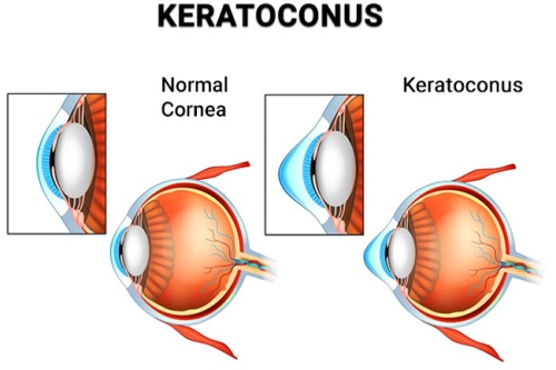 圆锥角膜眼球对比图