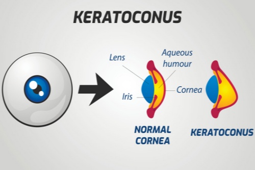圆锥角膜结构示意