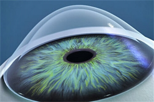 圆锥角膜示意图