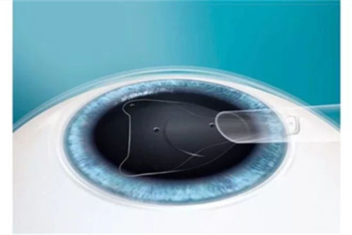 近视手术就选晶体植入?关于晶体植入手术的利弊,看完再决定做不做!