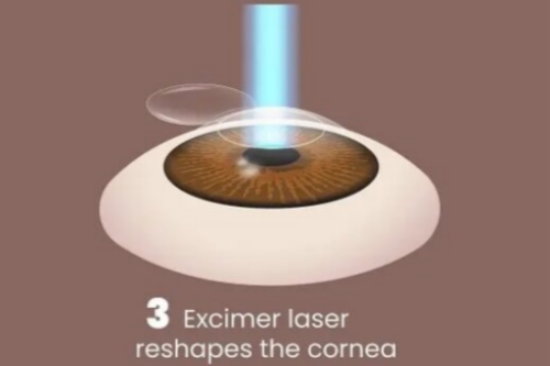 太原近视眼手术多少钱？激光手术8000元起、晶体植入手术32800元起！