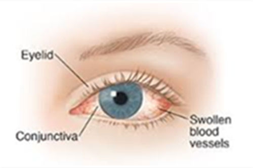 眼睛为什么会出现红血丝？红血丝很严重是怎么回事？怎么消除？