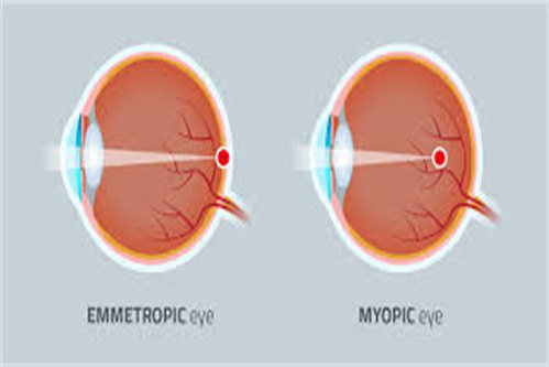 正常眼睛与近视眼睛对比示意图
