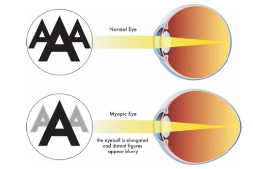 吃叶黄素对近视眼有帮助吗？叶黄素或许就是近视的答案？