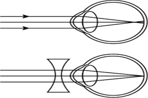 近视不带戴眼镜会不会导致度数加深？不确定！加重与许多因素有关，包括遗传、环境和生活习惯等