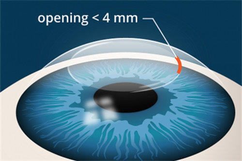 全飞秒手术动画示意图