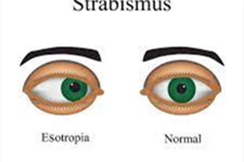 斜视是怎么造成的？斜视有哪些症状，怎么矫正才好？