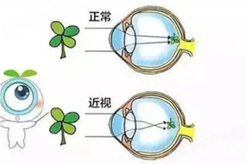 近视示意图