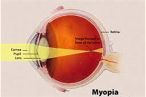 近视眼球示意图