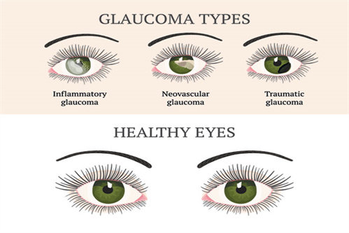 青光眼类型示意图