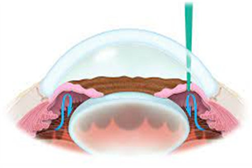 虹膜切除手术示意图