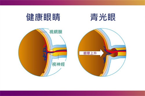 健康眼和青光眼