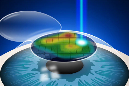 采访：夜跑司机亲述半飞秒手术的全程体验和术后感受！