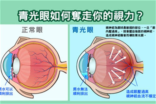 青光眼如何夺走视力