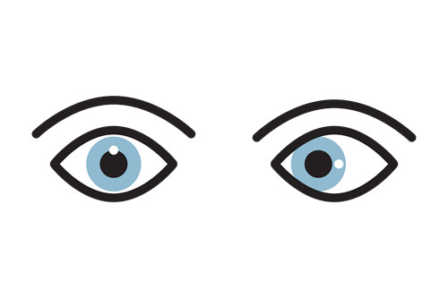 正常眼睛与斜视眼睛对比示意图 正常眼睛与斜视眼睛对比示意图