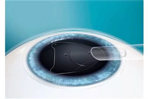 晶体植入手术