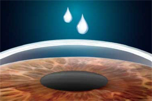 smart全激光手术示意图