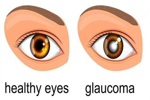 青光眼