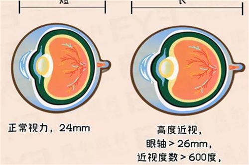 高度近视对比图