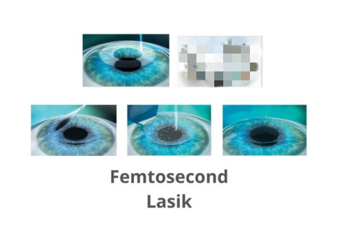 半飞秒手术过程示意图