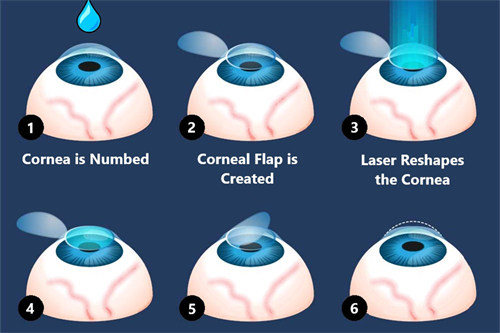 半飞秒手术示意图