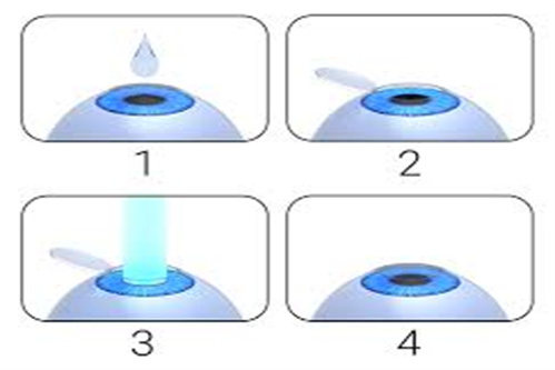 半飞秒手术过程动画示意图