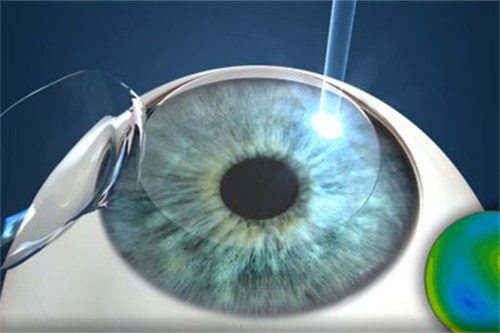 半飞秒手术动漫示意图