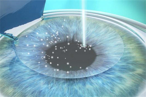 半飞秒手术图片示意图