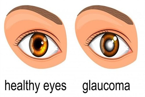 青光眼1
