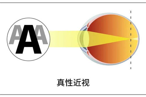 近视怎么矫正视力？晶体植入好还是飞秒好？这几点告诉你