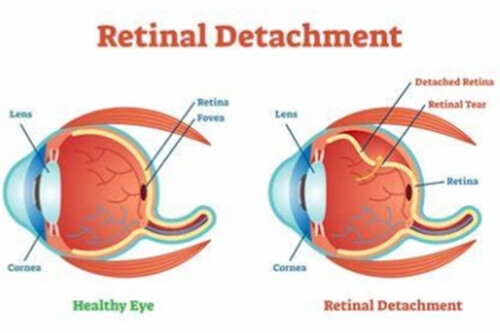 视网膜脱落情况
