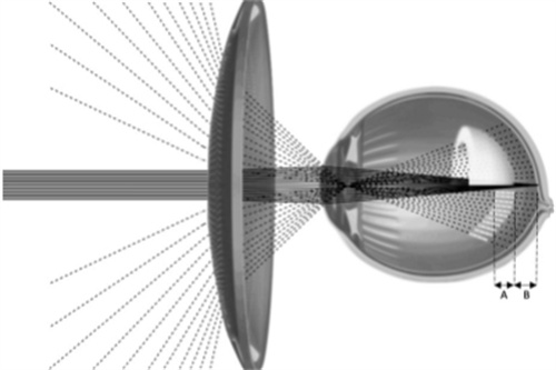 离焦眼镜示意图