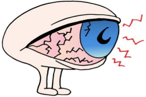 干眼症