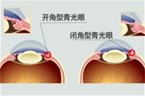 不同类型青光眼