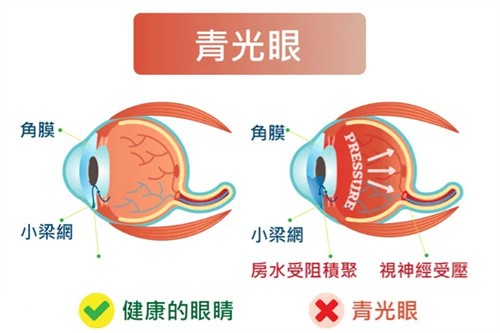 青光眼成因图