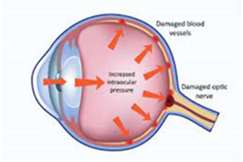 干货：眼压为什么会偏高？过高有什么风险？这几招教你缓解！