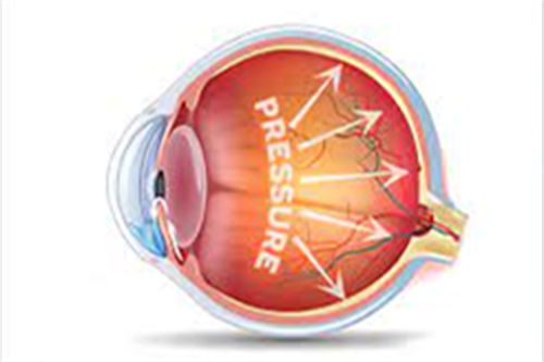 眼压高示意图