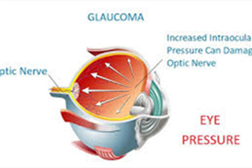 眼压高示意图