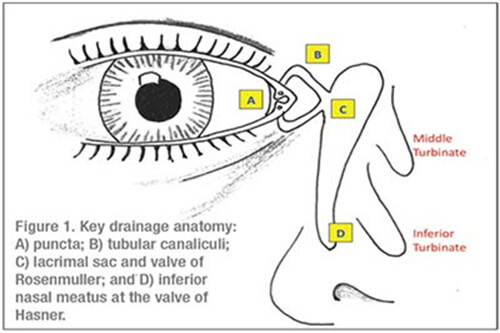 泪囊炎手术示意图