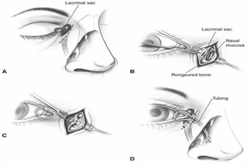 泪囊炎手术示意图