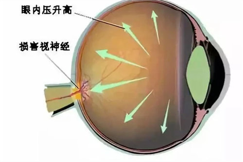 青光眼眼压升高